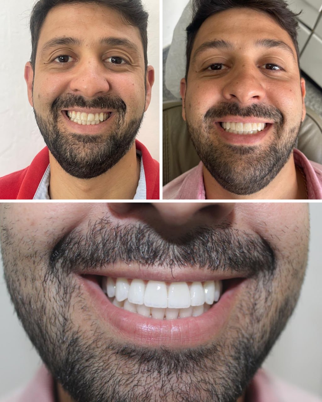 Antes e depois de sorriso