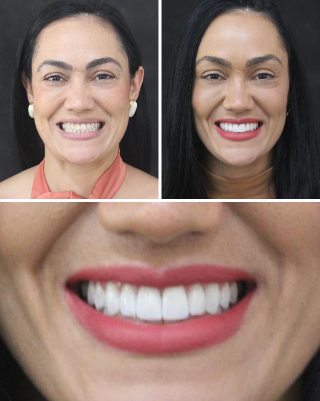 Antes e depois de tratamento odontológico